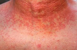 เชฌเซเชฐเชฟเชเชจเชฎเชพเช เชธเซเชเชพเชฐเชฒเซเช เชคเชพเชตเชจเชพ เซฉเซฆ เชนเชเชพเชฐเชฅเซ เชตเชงเซ เชเซเชธ เชธเชพเชฎเซ เชเชตเซเชฏเชพ, 16 เชฌเชพเชณเชเซเชจเชพ เชฅเชฏเชพ เชฎเซเชค